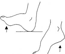 Гимнастика для голеностопного сустава: упражнения ЛФК для голеностопа Упражнения для укрепления голеностопных связок
